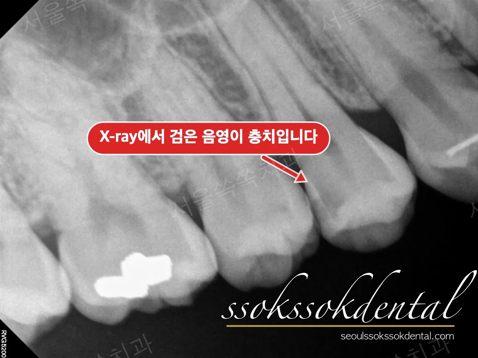 치근단 X-ray 인접면 충치
