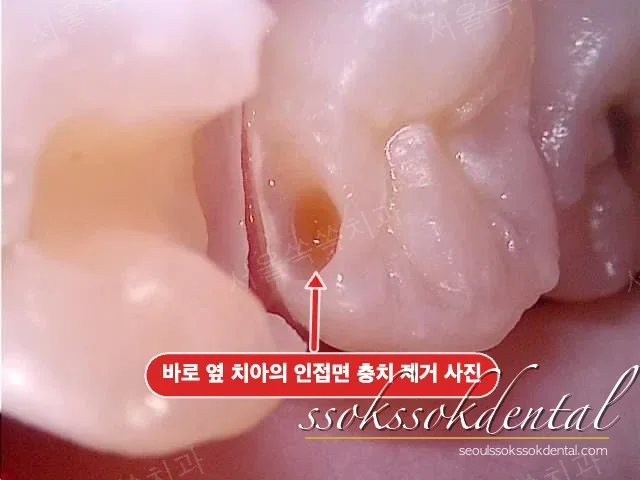 인접면 충치 제거 중 깊은 진행
