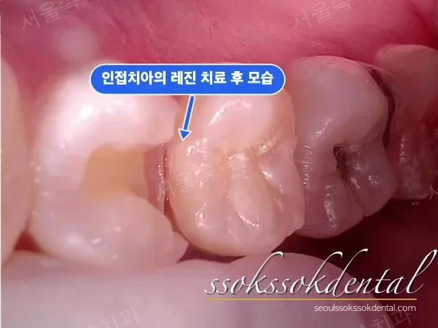 인접면 레진 수복 완료