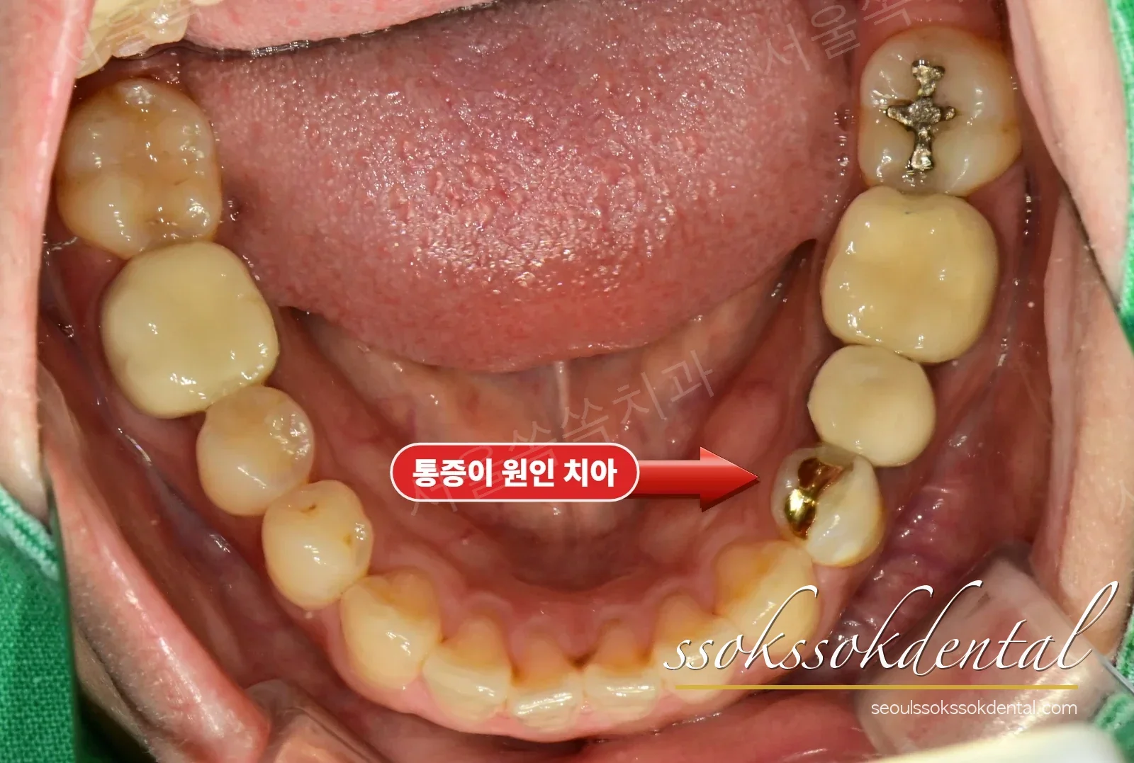 초진 아래 교합면 — 왼쪽 어금니 오래된 보철물
