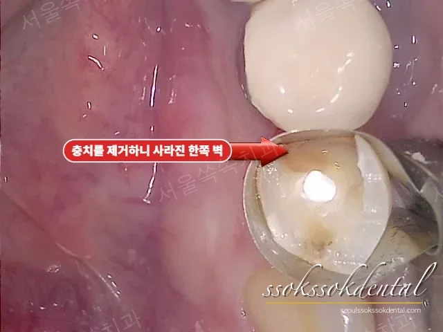 Tofflemire matrix band로 무너진 치아 벽을 대신할 틀 형성