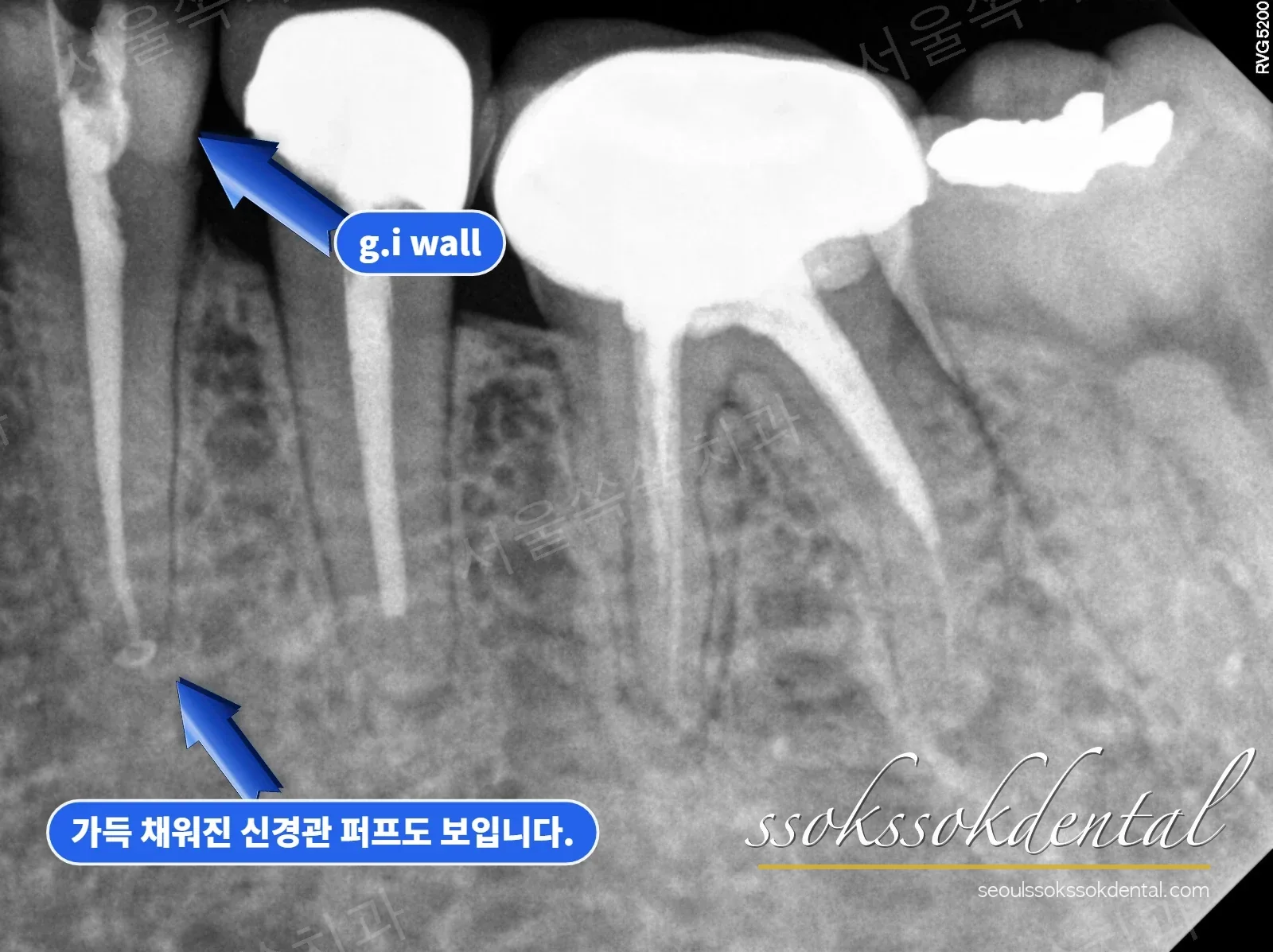 신경관을 뿌리 끝까지 가득 채운 근관충전 방사선