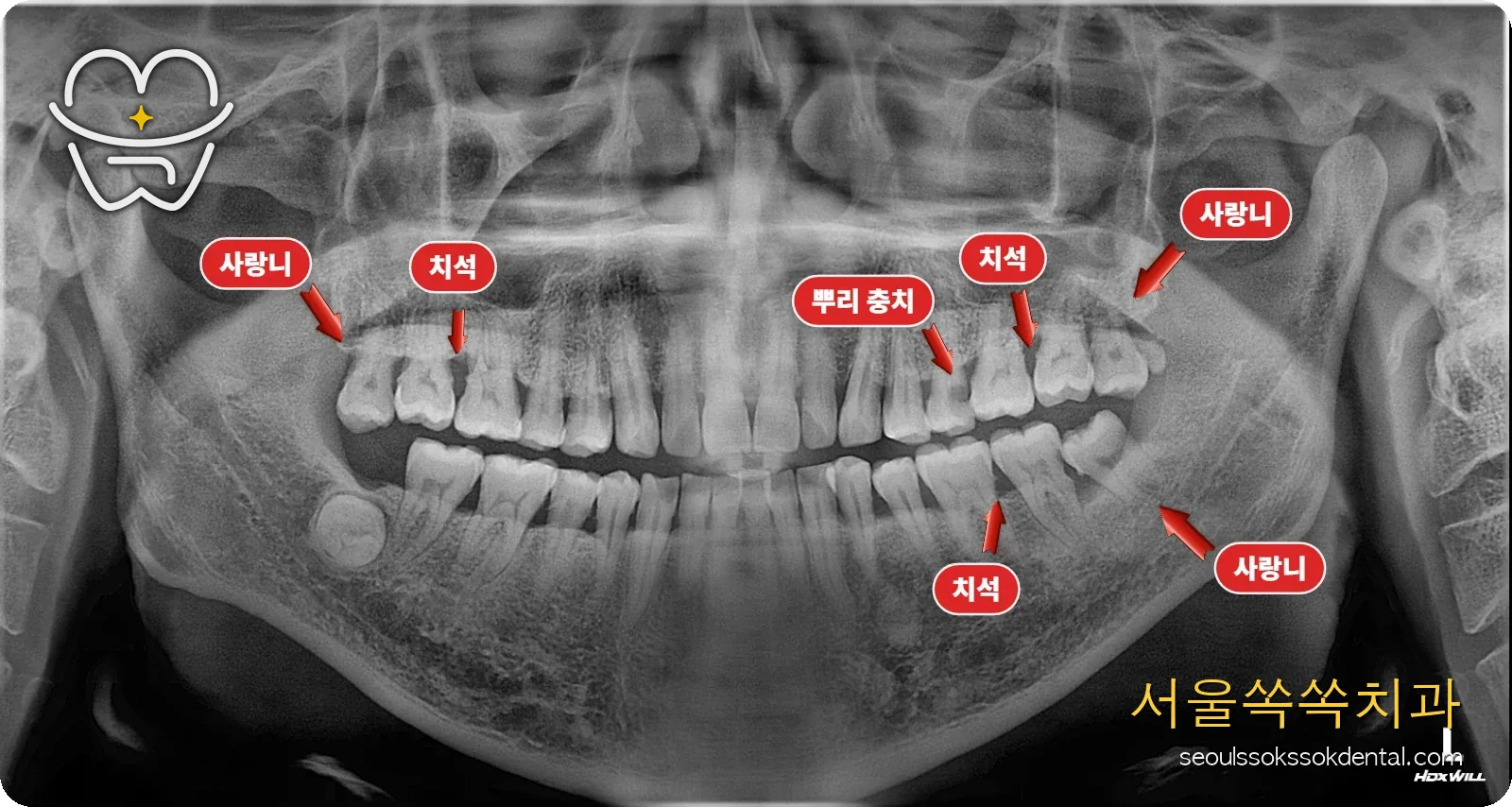 초진 파노라마 충치 사랑니 잇몸 진단
