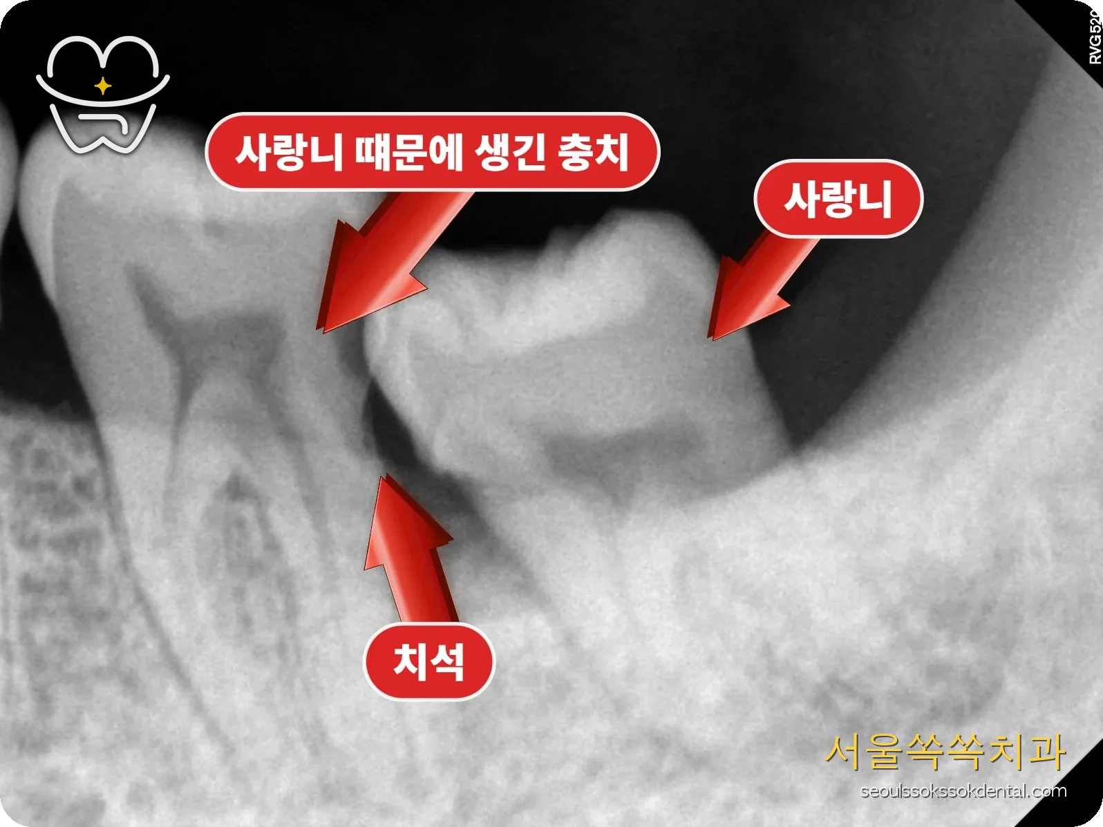 매복 사랑니 발치 전 PA