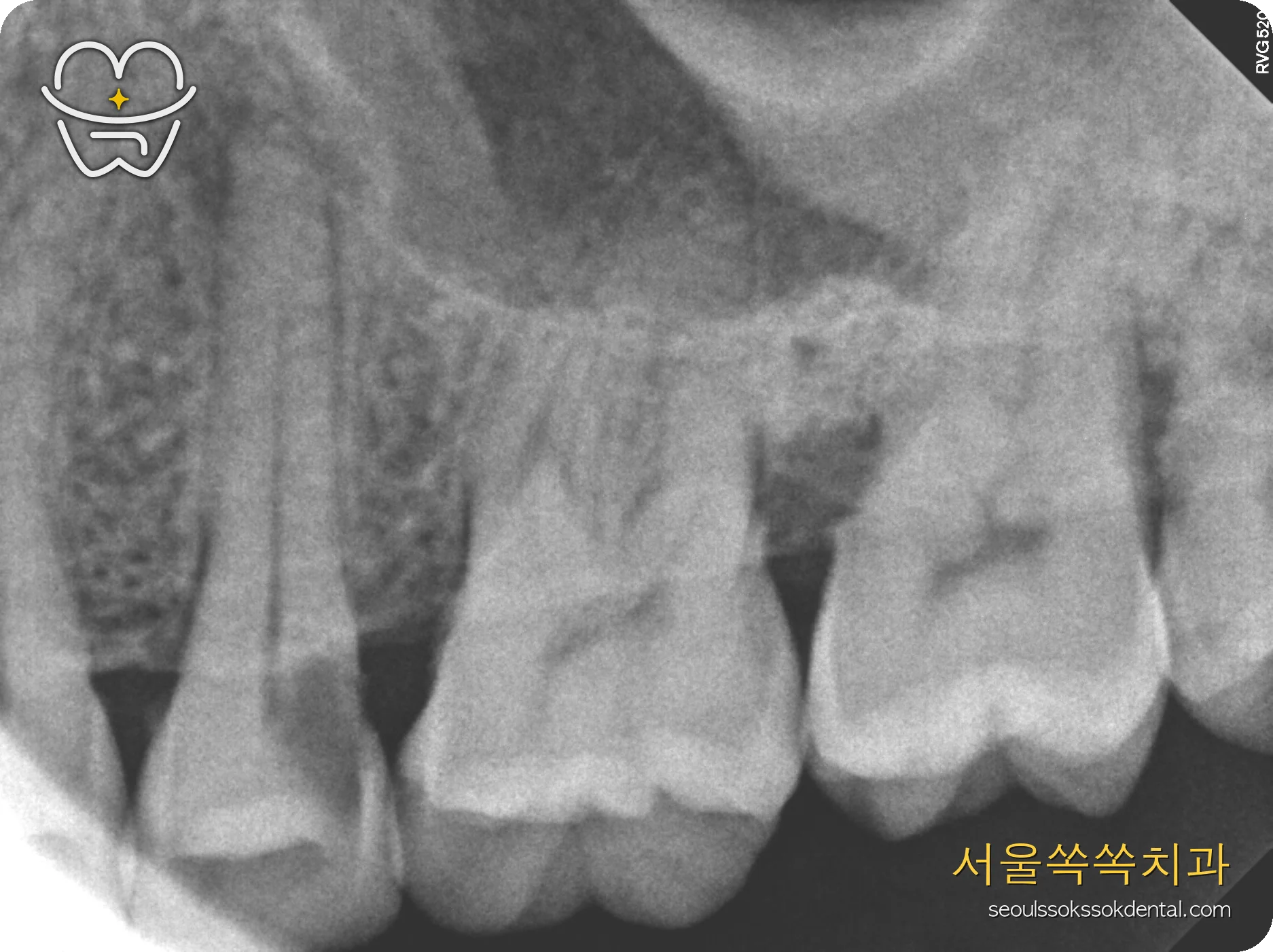 뿌리쪽 깊은 충치 치료 전 PA