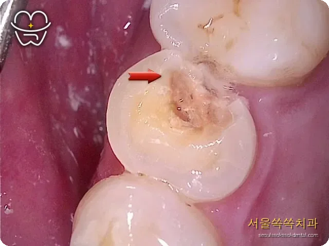 뿌리쪽 깊은 충치 확인 구강카메라