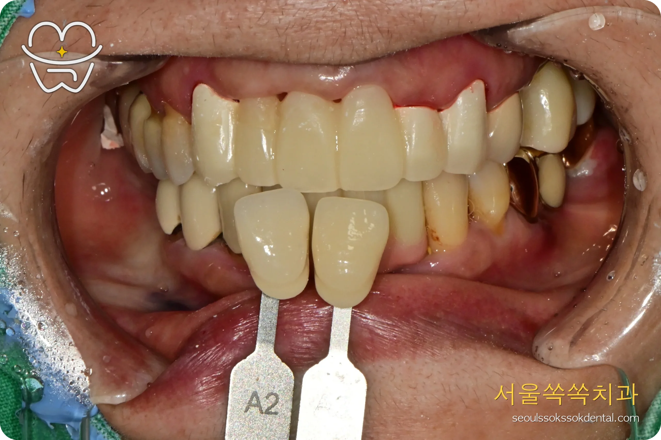 전치부 브릿지 색조 맞춤 과정