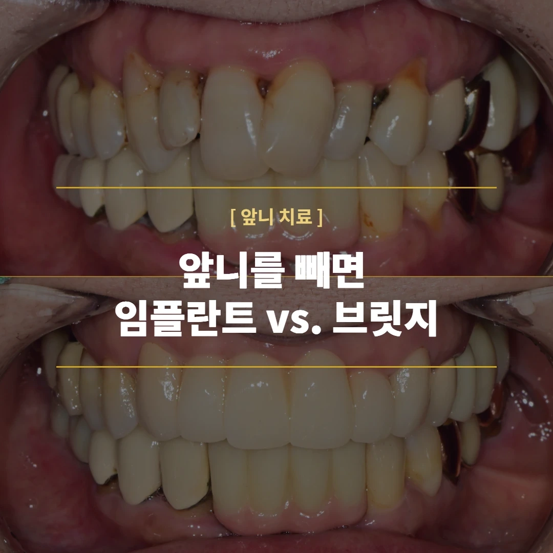 앞니가 흔들리면 무조건 임플란트일까요? — 골다공증 환자의 앞니 브릿지 심미 수복 (강서구 마곡 치과)