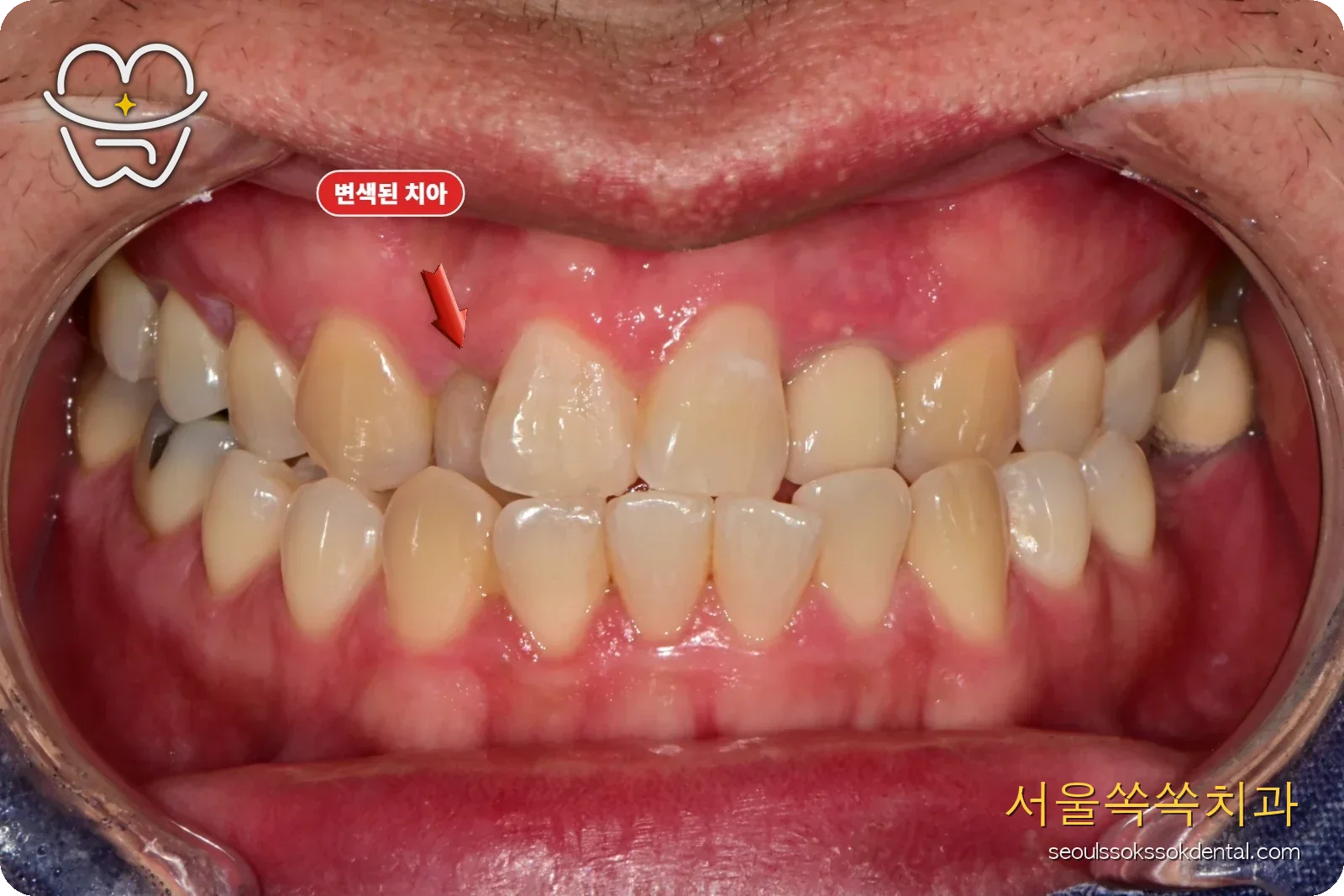 치료 전 정면 구강 사진