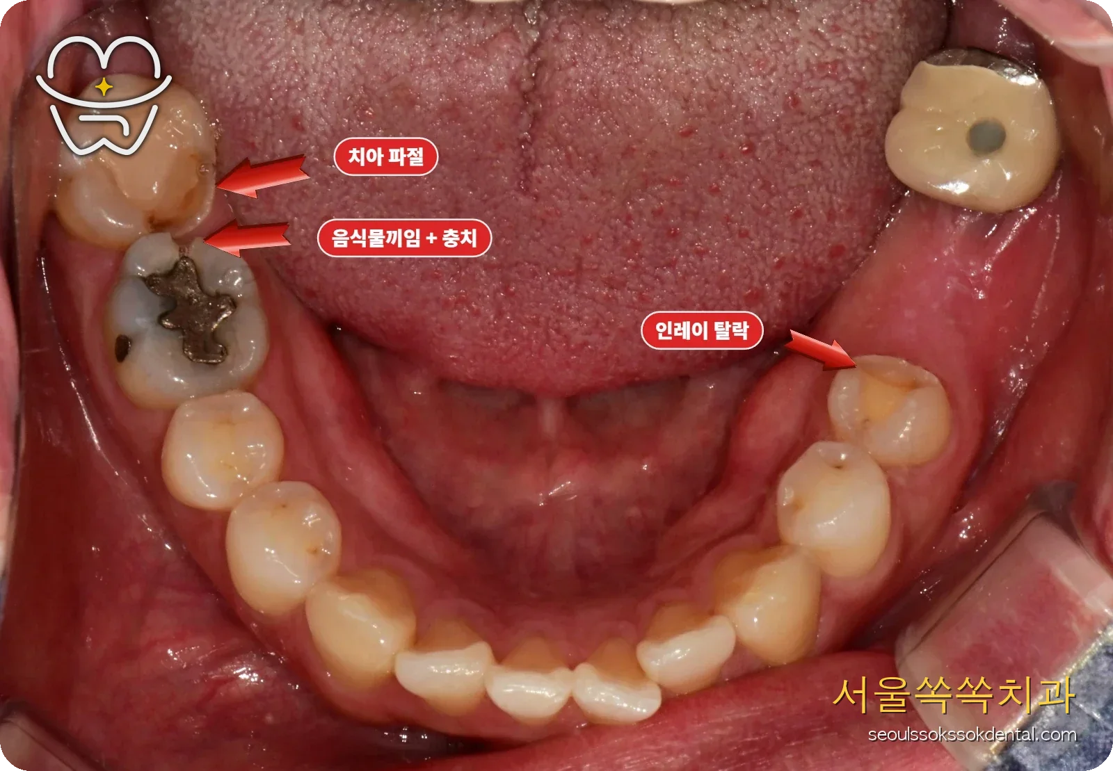 초진 하악 교합면 - 빈 어금니 자리와 양쪽 어금니 마모 상태