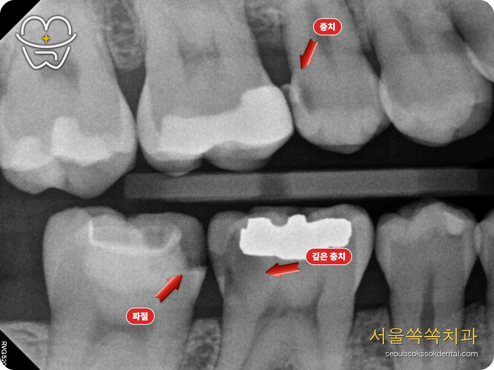 오른쪽 어금니 인접면 충치가 보이는 교익 엑스레이