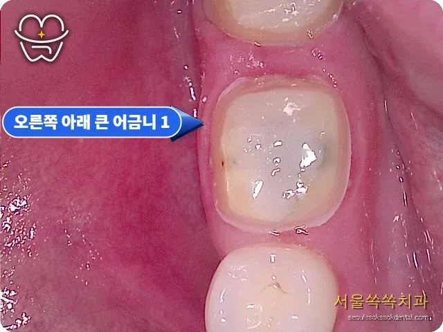 지르코니아 크라운 전 치아 삭제와 잇몸 경계 정리