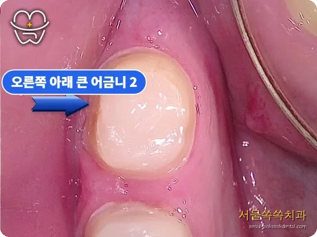 지르코니아 크라운 마진 형성 근접 사진