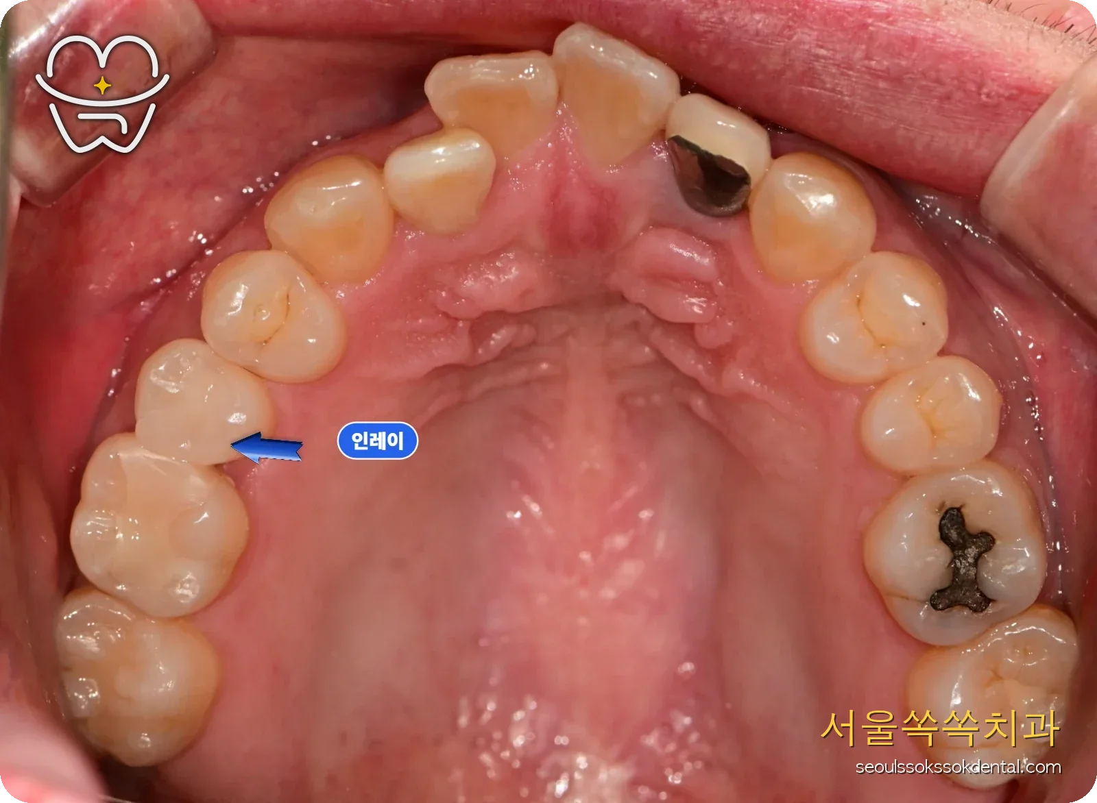 치료 완료 후 상악 교합면