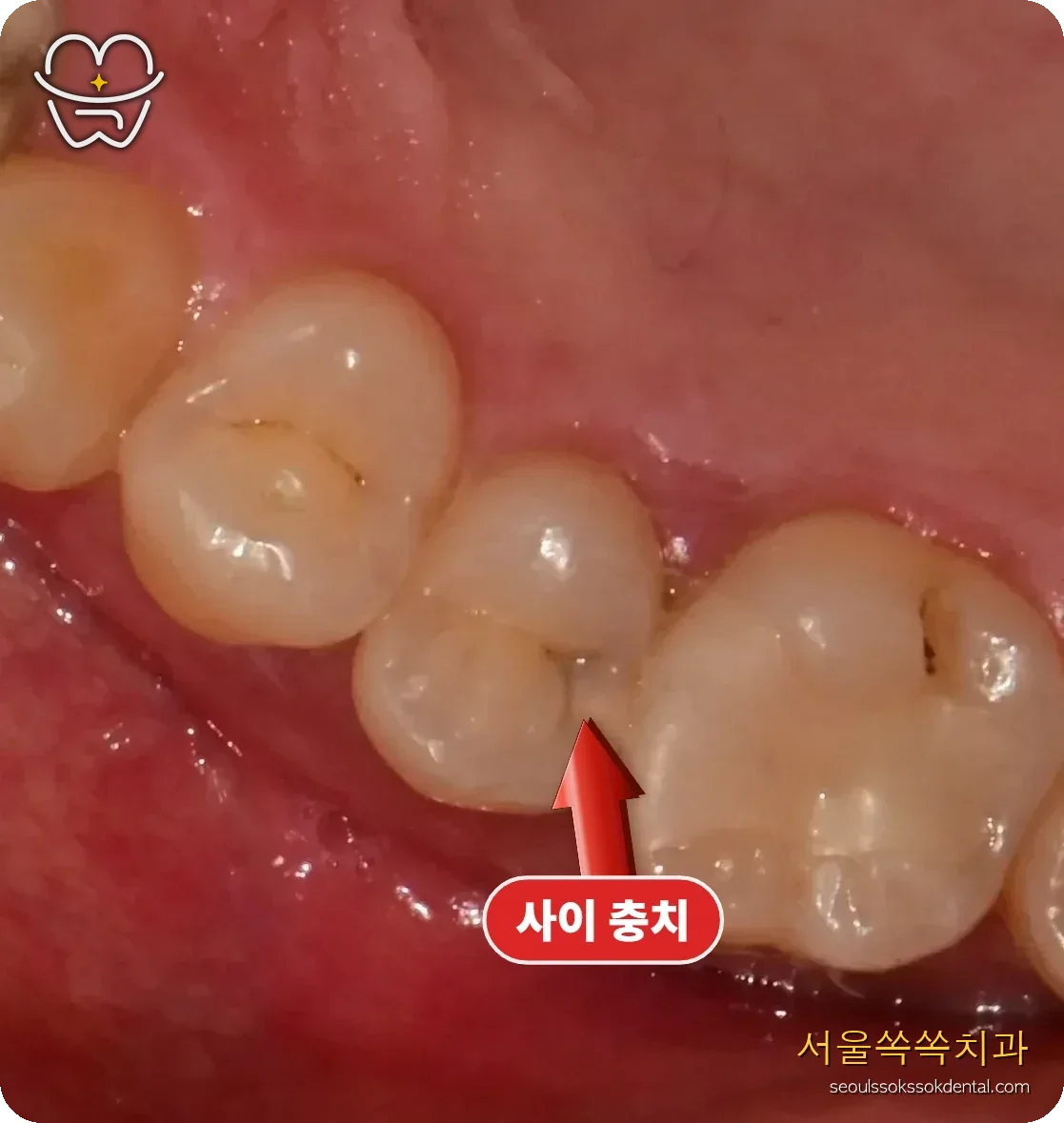 오른쪽 위 사이 충치