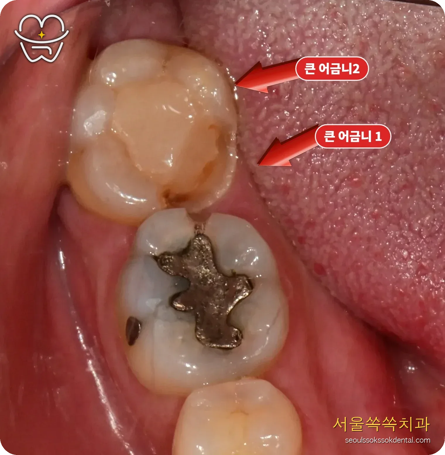 오른쪽 아래 큰 어금니 #46,47 치료 전 사진
