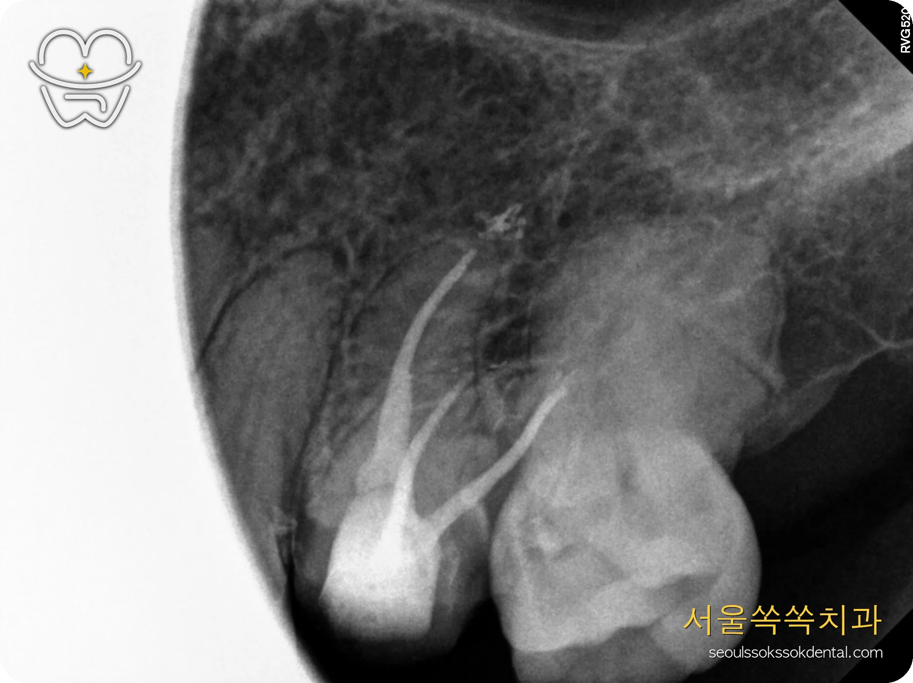 내려온 어금니 의도적 신경치료 근관충전