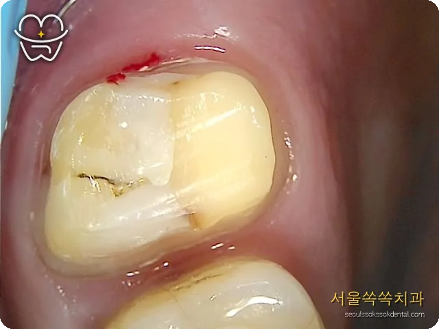 지르코니아 크라운 재제작 지대치 마진 사진